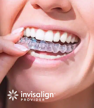 img-service-invisalign-01